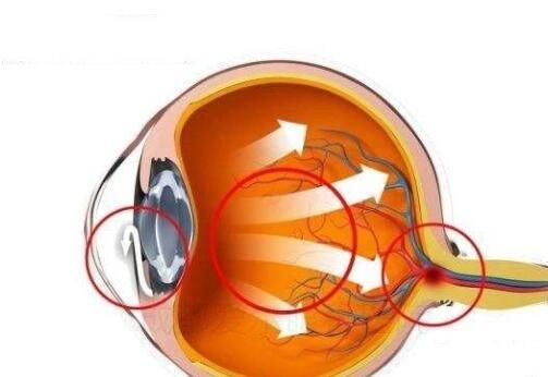 揭秘青光眼，眼睛青光眼究竟是如何引发的？